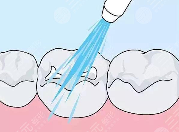 洗牙的好處有哪些？為什么要洗牙你看完就明白了