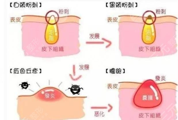 閉合性粉刺是什么樣的圖片