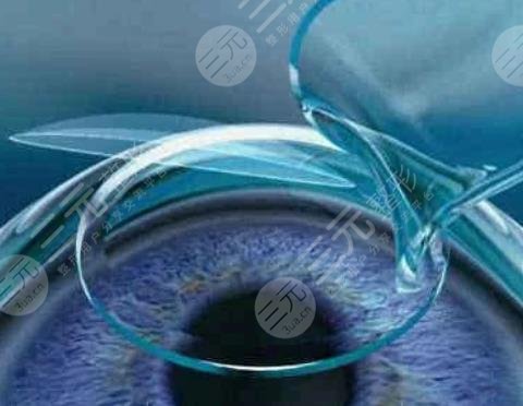 晶體植入近視手術(shù)的利與弊