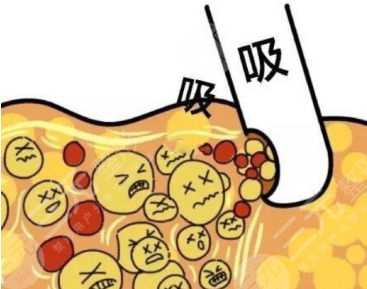 全身抽脂50斤的價格要5w？