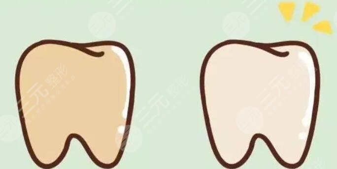 冷光美白牙齒優(yōu)勢是什么?