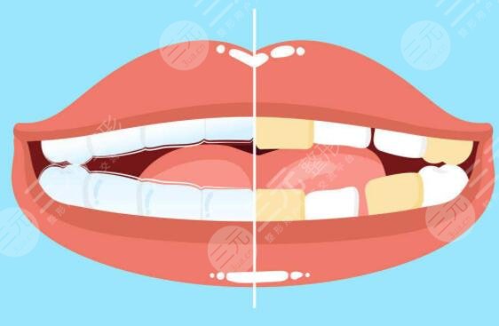 牙齒冷光美白多久見效?