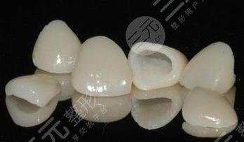 烤瓷牙的壽命是幾年?