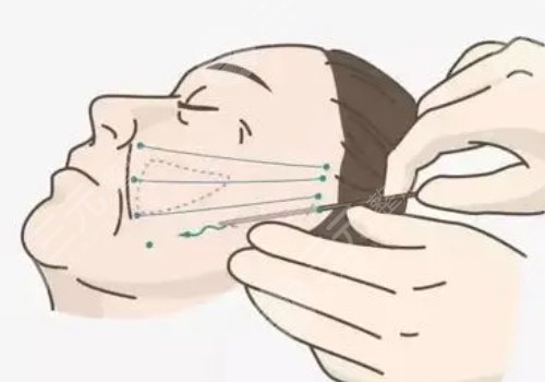 電波拉皮的危害和副作用有哪些?