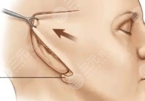 電波拉皮的危害和副作用有哪些?