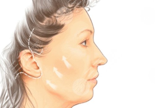 電波拉皮的危害和副作用有哪些?