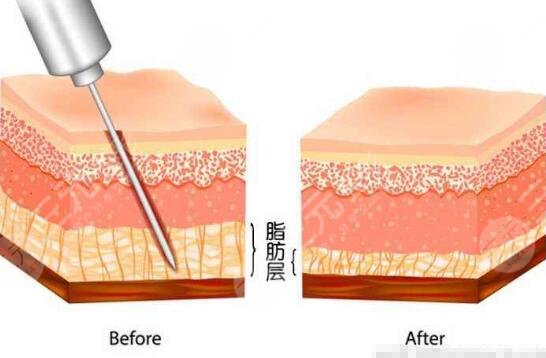 男士乳房肥大吸脂手術(shù)費(fèi)用多少？?jī)r(jià)格標(biāo)準(zhǔn)公開！術(shù)前科普~