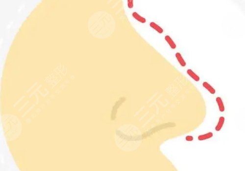 打玻尿酸隆鼻子有副作用嗎？