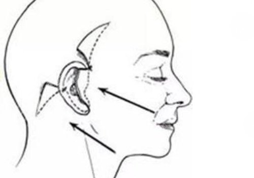 筋膜復(fù)位術(shù)能保持多久?