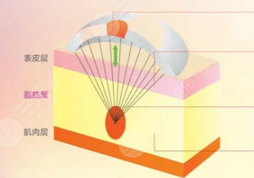 電波拉皮和熱瑪吉的區(qū)別在哪？