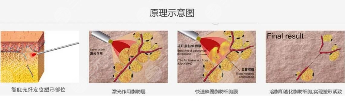鐳射溶脂的操作原理