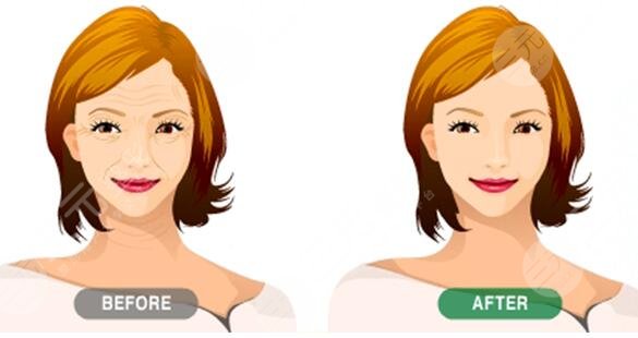 影響全面部懸吊術(shù)的價格因素有哪些?