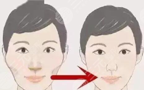 微創(chuàng)顴骨整形手術費用是多少?