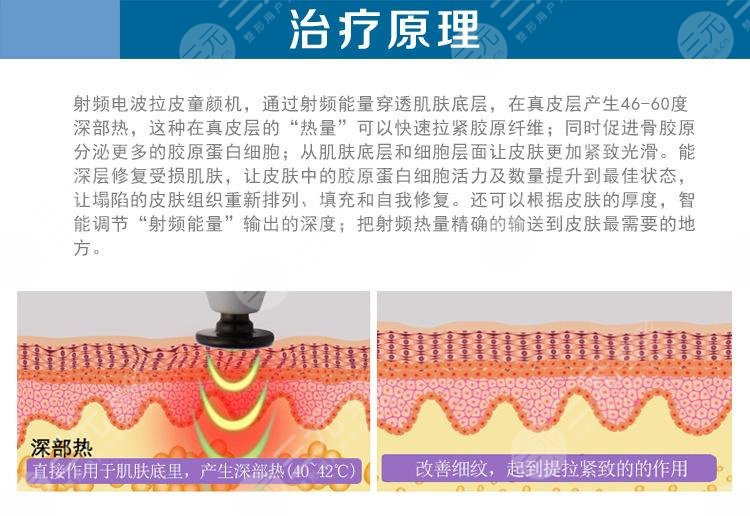 電波拉皮和熱瑪吉的區(qū)別在哪？