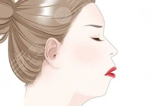 下顎線提升整形有什么做法？