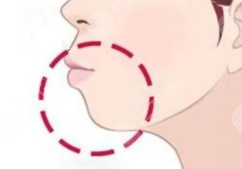 下顎線提升整形有什么做法？