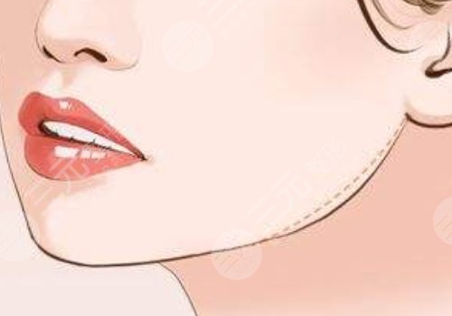 下顎線提升整形有什么做法？