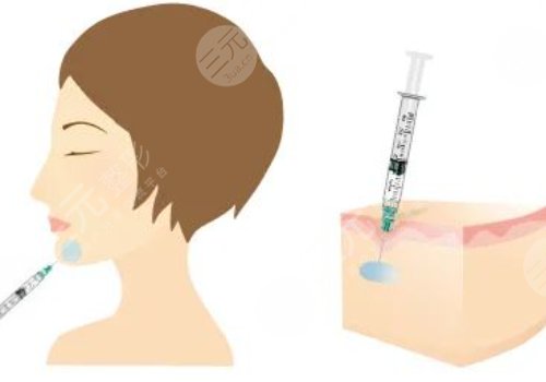 下顎線提升整形有什么做法？