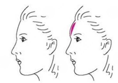 　　在日常的生活當(dāng)中，如果有的愛(ài)美人士想要通過(guò)一些好的方式來(lái)改良面部?jī)?nèi)輪廓以及外輪廓的話，可以通過(guò)吸脂以及注射一些好的物質(zhì)，還有手術(shù)的方式來(lái)進(jìn)行改良。  　　做面部?jī)?nèi)輪廓以及外輪廓，建議愛(ài)美人士在手術(shù)之前做好對(duì)于自己臉部方面的檢查，這樣的話容易根據(jù)自己實(shí)際情況來(lái)選擇合適的做這項(xiàng)手術(shù)的方式，也能夠幫助愛(ài)美人士有效的排出臉部當(dāng)中的一些脂肪，或者是改良愛(ài)美人士臉部當(dāng)做一些比較突出的骨頭。  　　達(dá)到一個(gè)比較理想的改良內(nèi)外輪廓的效果。建議愛(ài)美人士如果咬合肌比較大的話，可以通過(guò)注射一些玻尿酸以及其他的物質(zhì)來(lái)進(jìn)行緩解，這樣的話能夠起到一定的整形手術(shù)效果。