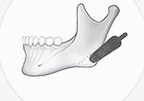 　　在日常的生活當(dāng)中，如果有的愛(ài)美人士想要通過(guò)一些好的方式來(lái)改良面部?jī)?nèi)輪廓以及外輪廓的話，可以通過(guò)吸脂以及注射一些好的物質(zhì)，還有手術(shù)的方式來(lái)進(jìn)行改良。  　　做面部?jī)?nèi)輪廓以及外輪廓，建議愛(ài)美人士在手術(shù)之前做好對(duì)于自己臉部方面的檢查，這樣的話容易根據(jù)自己實(shí)際情況來(lái)選擇合適的做這項(xiàng)手術(shù)的方式，也能夠幫助愛(ài)美人士有效的排出臉部當(dāng)中的一些脂肪，或者是改良愛(ài)美人士臉部當(dāng)做一些比較突出的骨頭。  　　達(dá)到一個(gè)比較理想的改良內(nèi)外輪廓的效果。建議愛(ài)美人士如果咬合肌比較大的話，可以通過(guò)注射一些玻尿酸以及其他的物質(zhì)來(lái)進(jìn)行緩解，這樣的話能夠起到一定的整形手術(shù)效果。