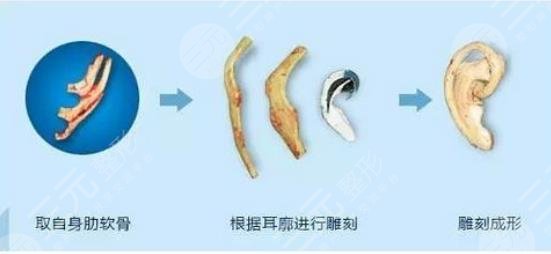 外耳再造手術需要多少費用？價格表大全，匯總分享！