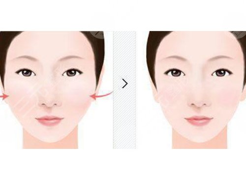 面部輪廓固定針能維持多久？作用如何？