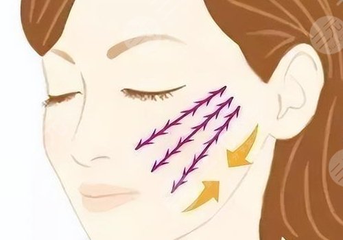 怎樣提升面部下垂？