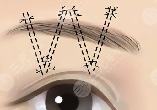 提眉的好處和壞處有什么？