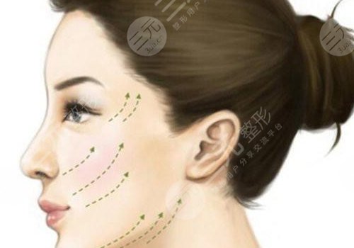 輪廓提升多久有效果？