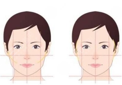 面部輪廓固定需要多少錢？