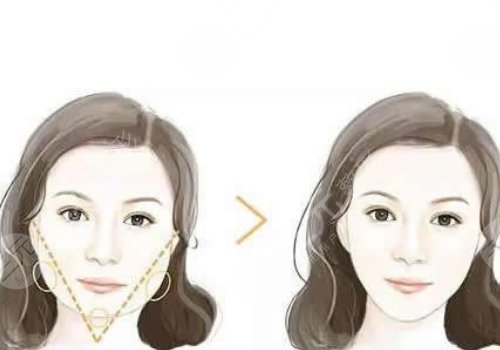 面部輪廓固定需要多少錢？