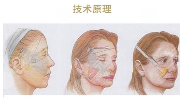 在做了雙燕尾拉皮手術(shù)之后需要注意什么?