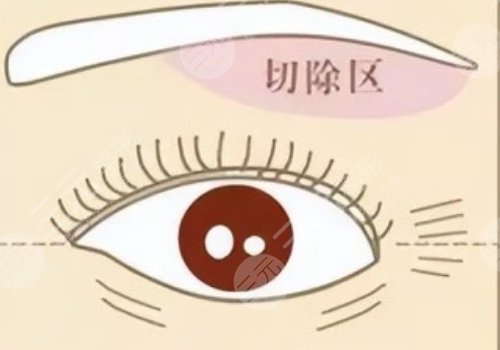 提眉術(shù)多久可以恢復自然？