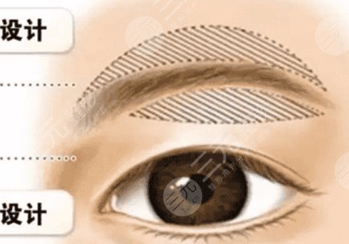 提眉術(shù)多久可以恢復自然？