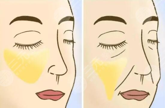 小拉皮手術之后能夠維持多長時間?