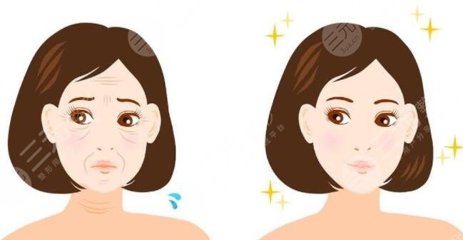 什么是雙燕尾拉皮手術(shù)？