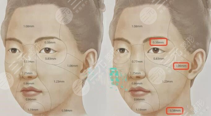 雙燕尾拉皮適合人群