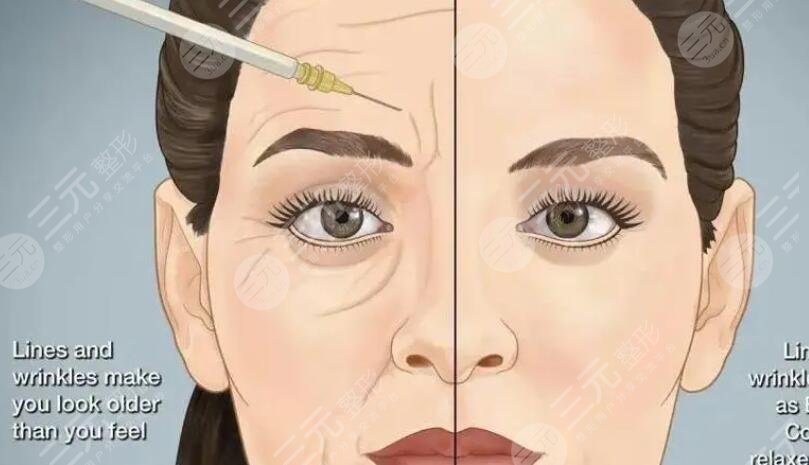 雙燕尾拉皮手術(shù)注意事項(xiàng)