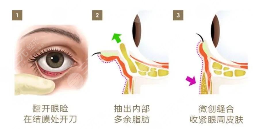 外切眼袋加眶隔釋放加填充淚溝