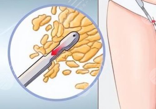 北京清木醫(yī)療美容診所吸脂怎么樣？