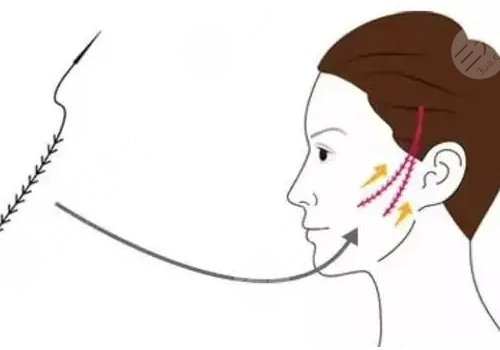 做完線雕多久可以恢復(fù)？