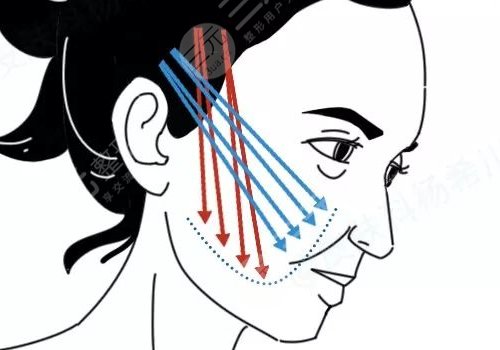 做完線雕多久可以恢復(fù)？