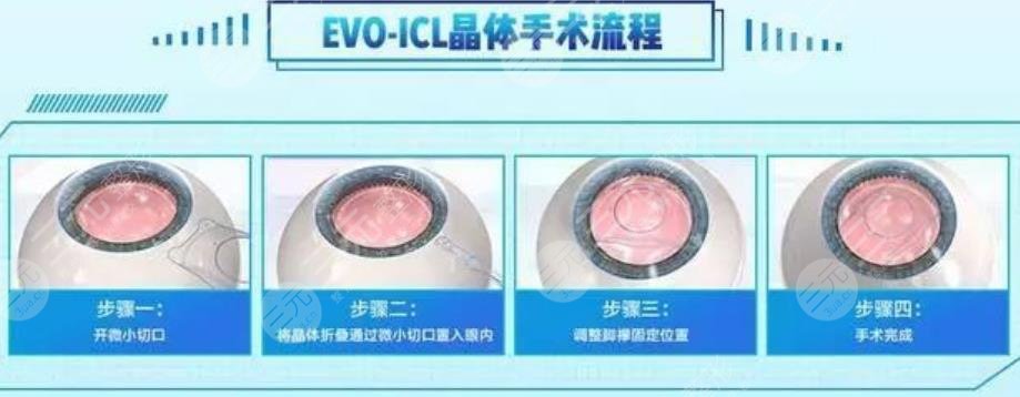 晶體植入手術(shù)的利與弊