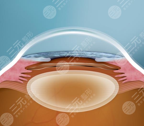 晶體植入手術(shù)的利與弊