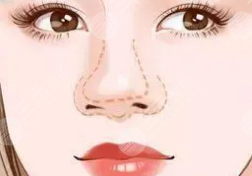 顧新安做鼻子怎樣？