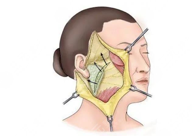 王馳醫(yī)生拉皮手術(shù)案例