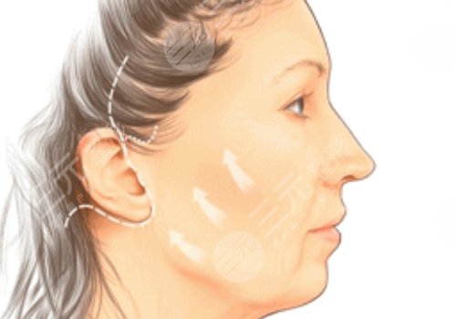 線雕臉1到7天恢復過程圖片