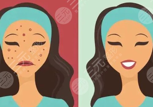 痘印怎么消除？