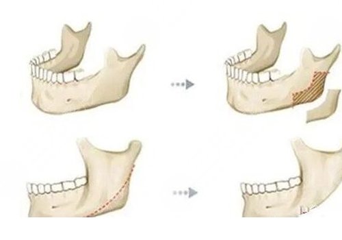 做輪廓手術(shù)多少錢(qián)費(fèi)用是多少？