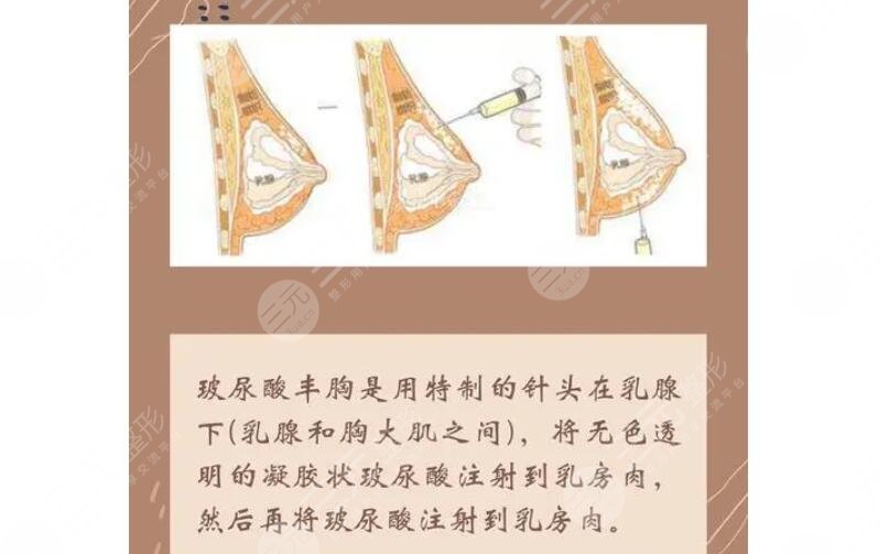 豐胸有效天然的方法有哪些?